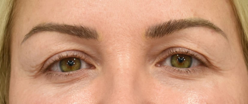 Brow Lift Patient 3 Set 1 Before